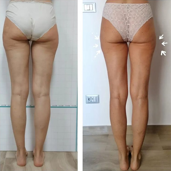 Prima e dopo trattamento anticellulite — Valeria, 10 sedute