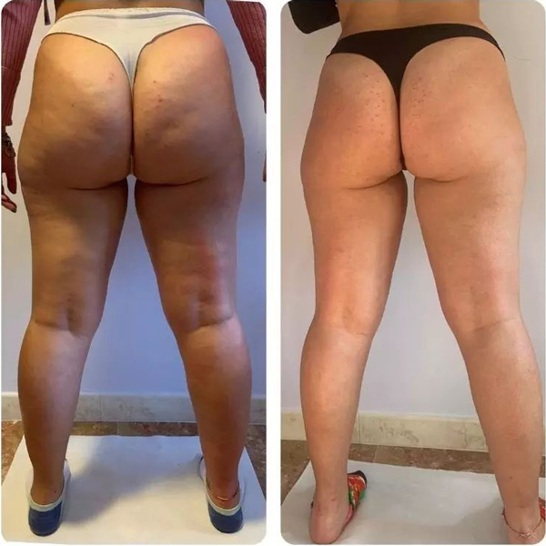 Prima e dopo trattamento anticellulite — Claudia, 5 sedute
